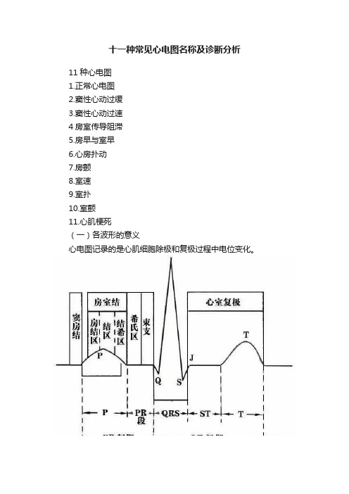 十一种常见心电图名称及诊断分析