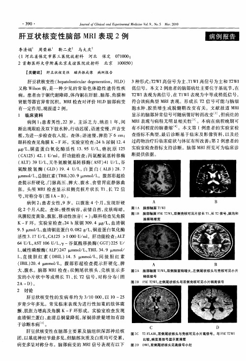 肝豆状核变性脑部MRI表现2例