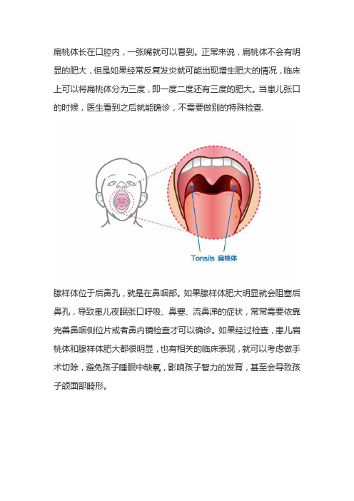 腺样体肥大和扁桃体肥大的区别