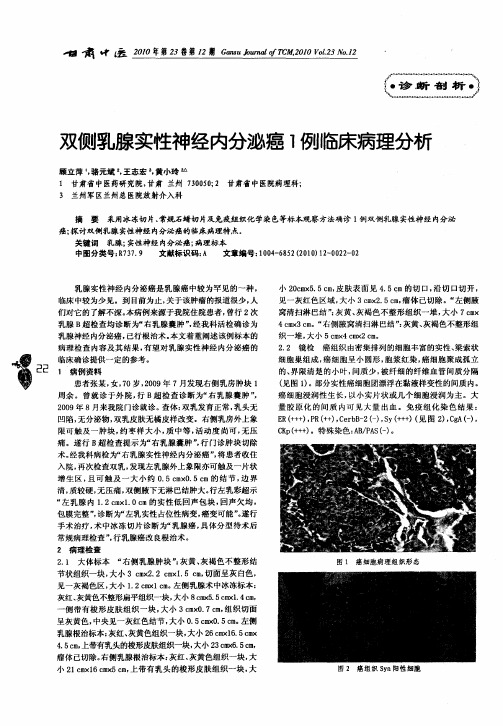 双侧乳腺实性神经内分泌癌1例临床病理分析