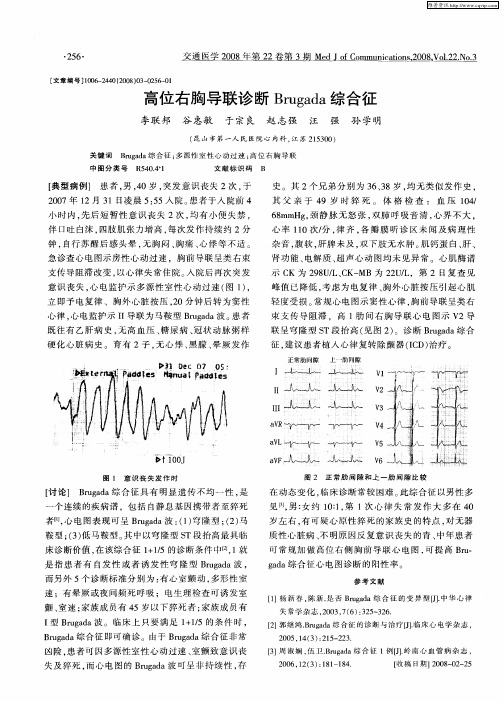 高位右胸导联诊断Brugada综合征