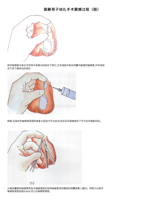 图解男子结扎手术震撼过程（图）