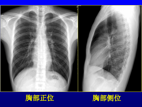 影像诊断学2-3-图片-呼吸系统正常、基本病变、肺炎课件