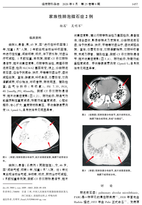 家族性肺泡微石症2例