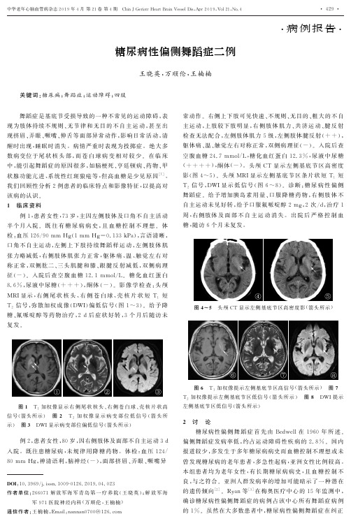 糖尿病性偏侧舞蹈症二例