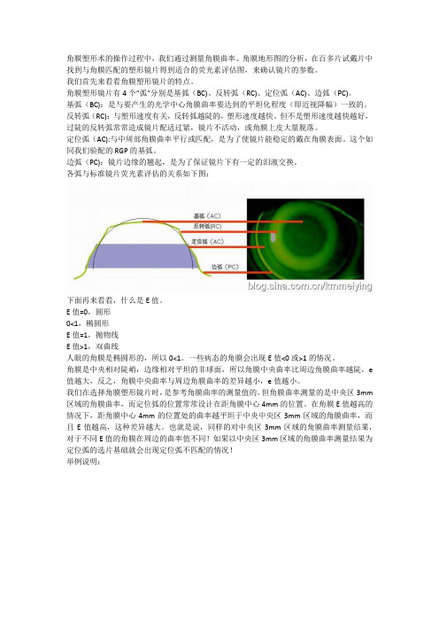 角膜塑形镜