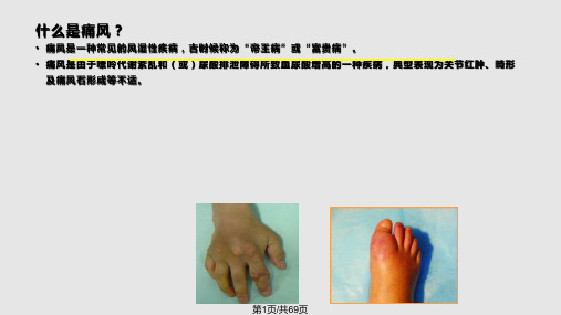 痛风健康科普讲座PPT课件