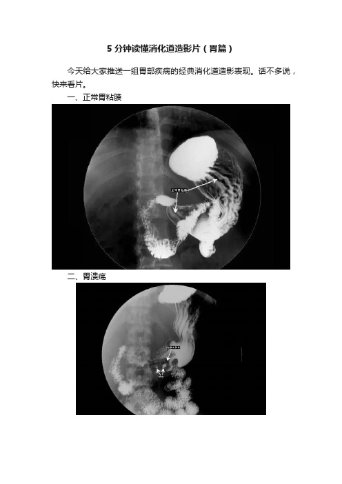 5分钟读懂消化道造影片（胃篇）