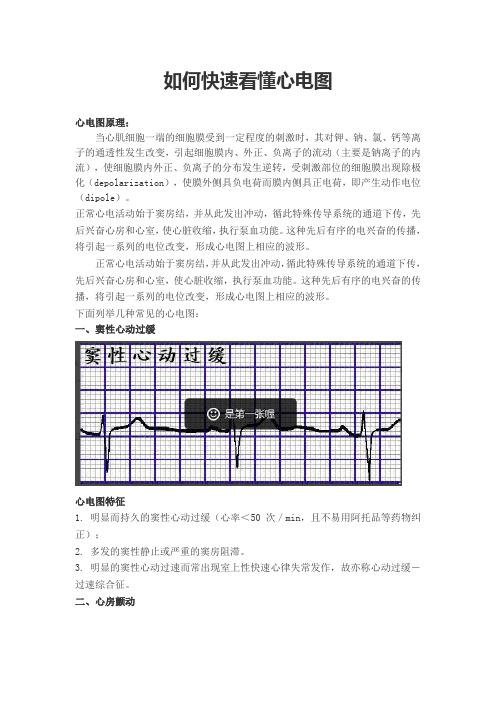 如何快速看懂心电图