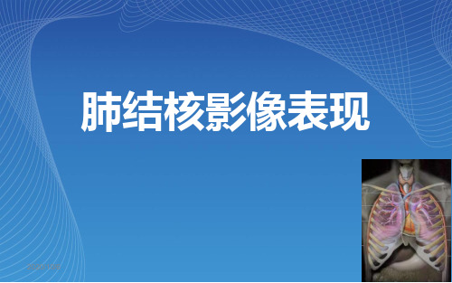 【影像诊断课件】肺结核影像表现(示教片)