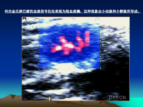 淋巴瘤的超声诊断参考幻灯片