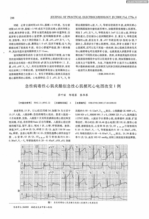 急性病毒性心肌炎酷似急性心肌梗死心电图改变1例